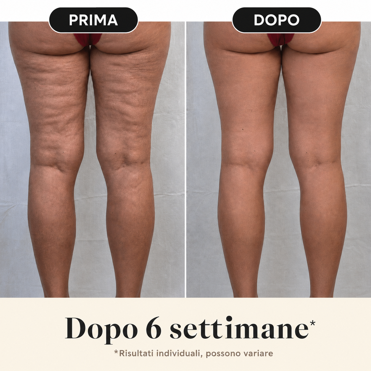 BodyLift — la prima crema in Italia con veleno d'api ad alto dosaggio contro la cellulite