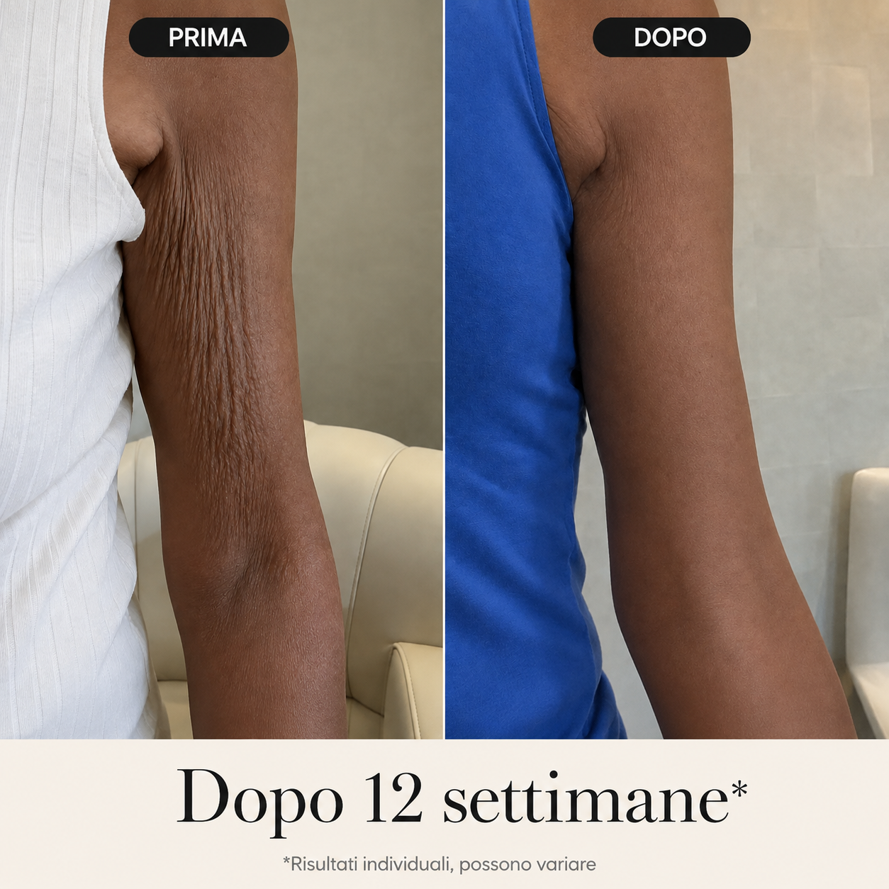 BodyLift — la crema al veleno d’api ad alto dosaggio per la pelle molle e increspata delle braccia